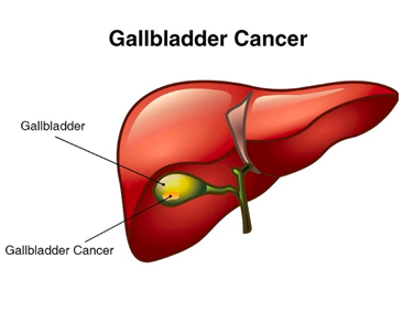 GALLBLADDER CANCER mission gastro hospital